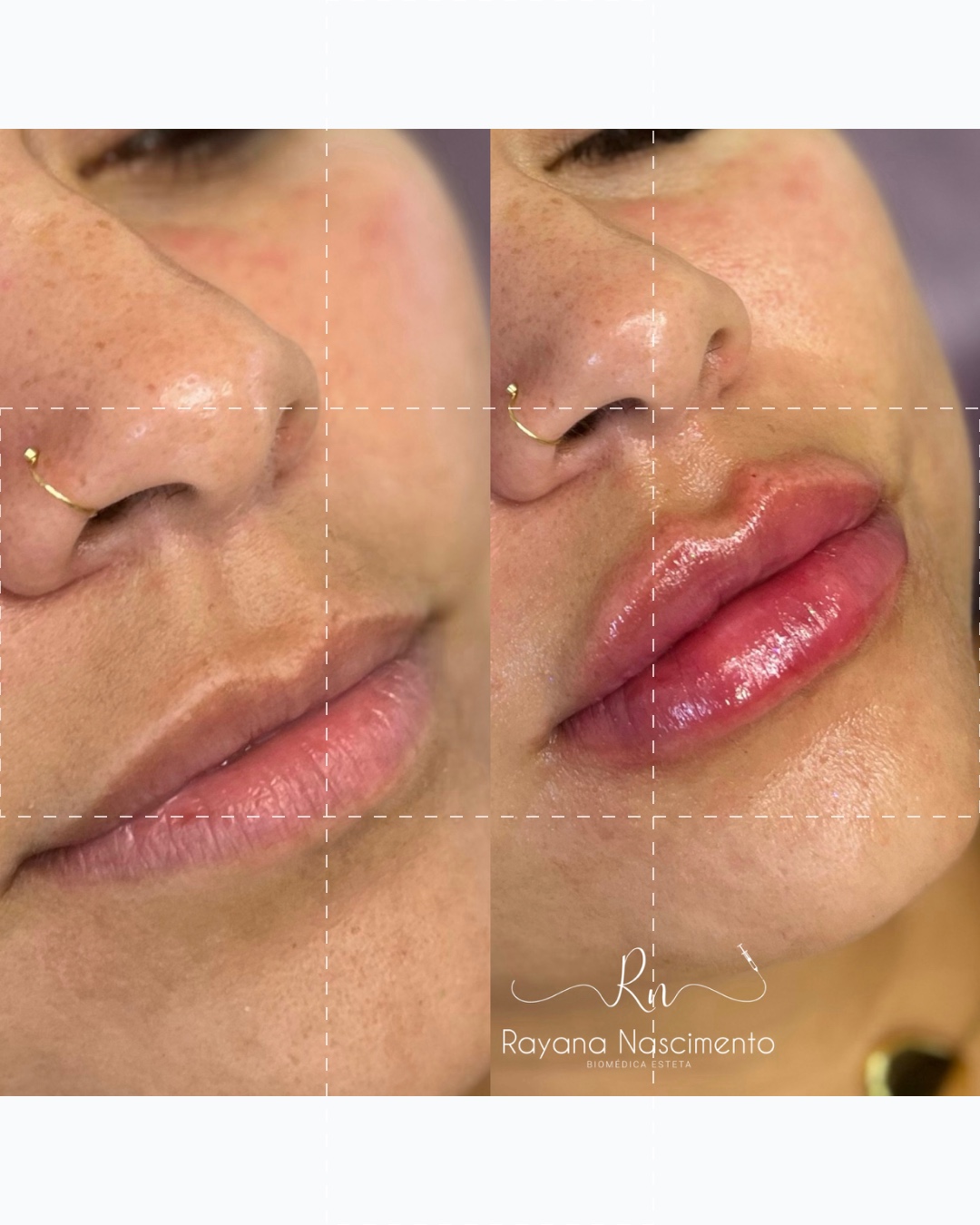 Preenchimento labial Ray Lips