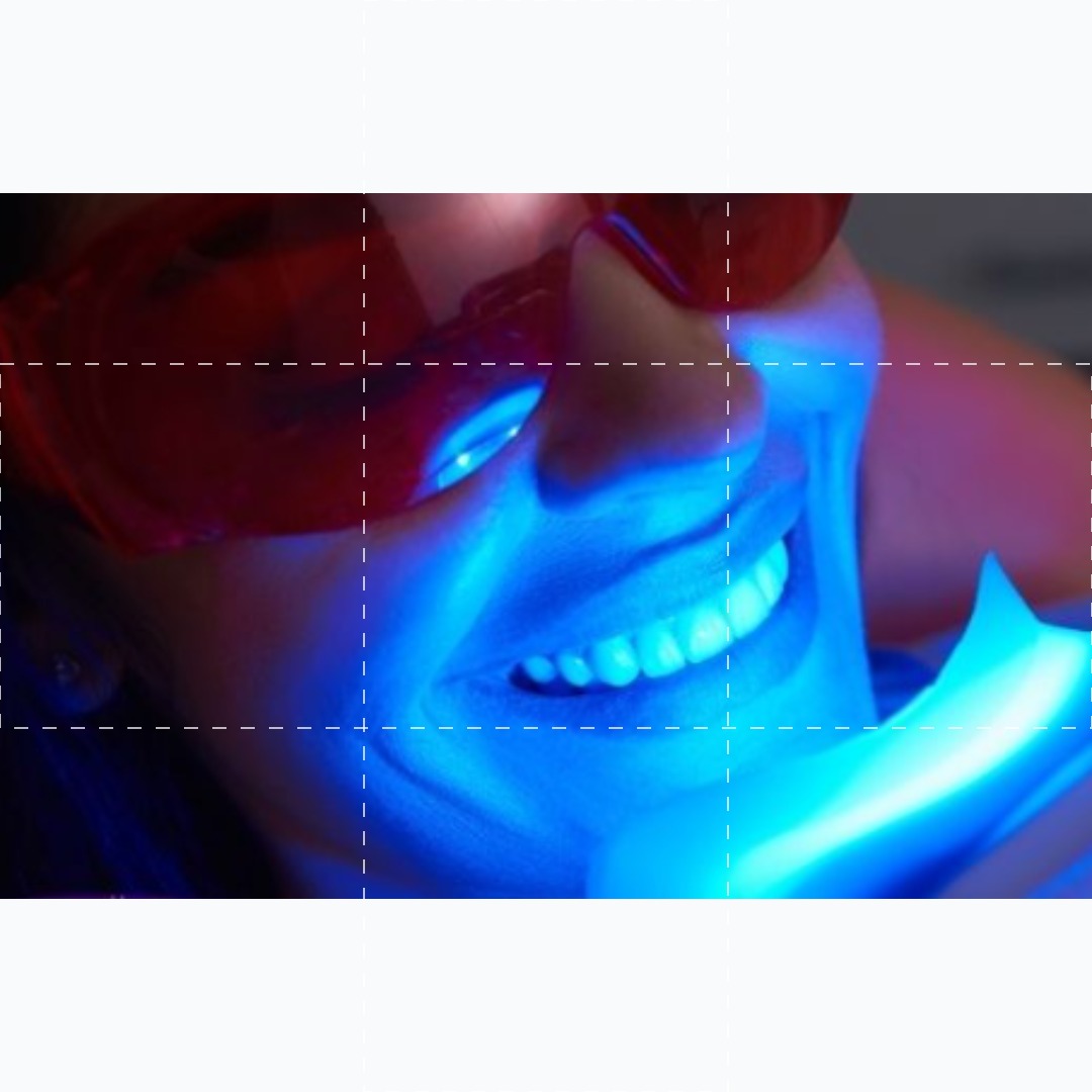Profilaxia e Clareamento a Laser